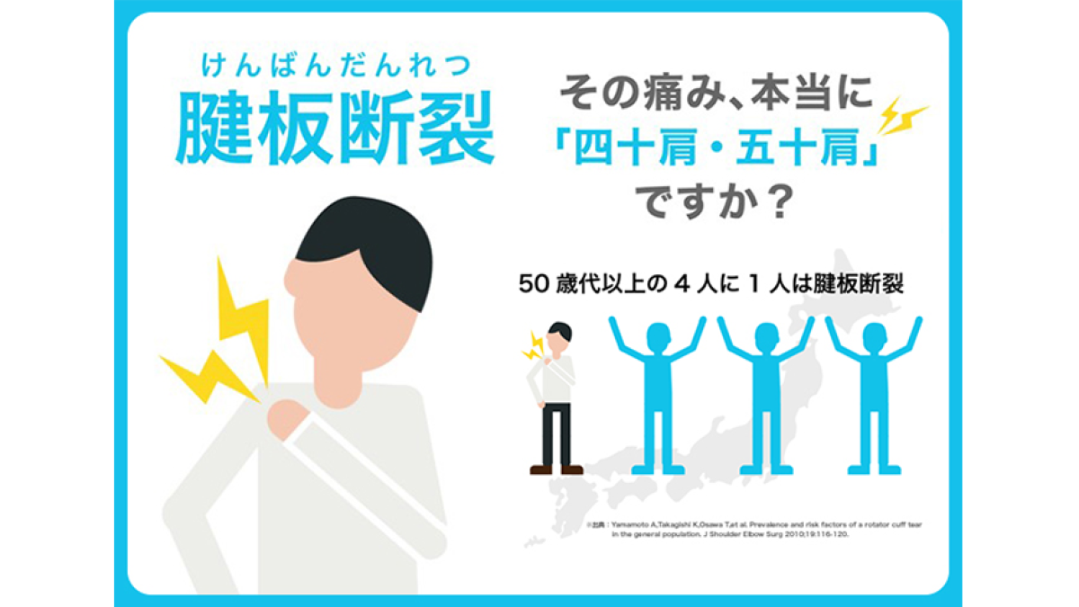 四十肩 五十肩という思い込みに要注意 早期診断が大切な 腱板断裂 とは ジョンソン エンド ジョンソン メディカル カンパニー