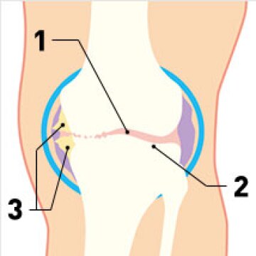 人工膝関節って なに 人工膝関節 やさしい医療講座 一般の方 ジョンソン エンド ジョンソン株式会社メディカルカンパニー ジョンソン エンド ジョンソン